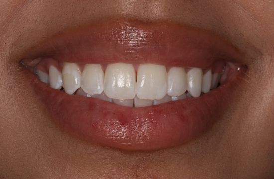 After -Optima Dental Care