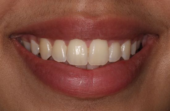 Before -Optima Dental Care