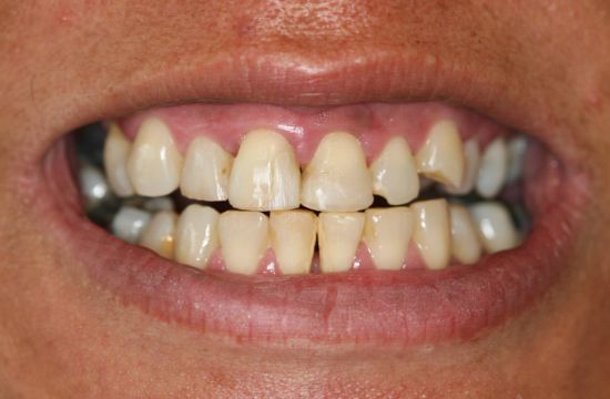 Before -Optima Dental Care