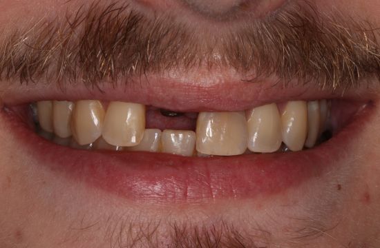 Before -Optima Dental Care