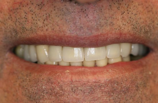 After -Optima Dental Care