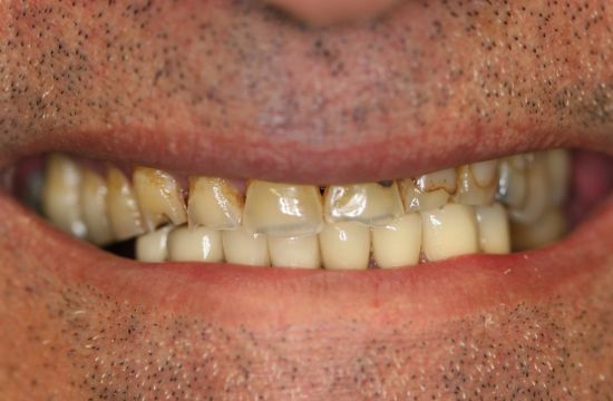 Before -Optima Dental Care