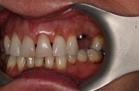 Before -Optima Dental Care