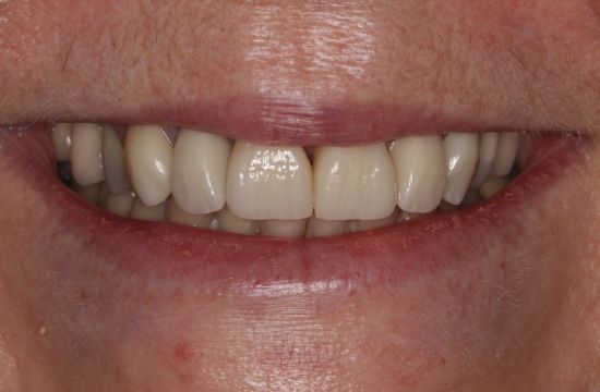 After -Optima Dental Care