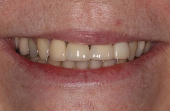 Before -Optima Dental Care