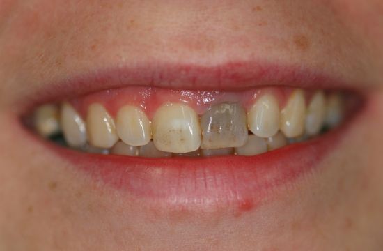 Before -Optima Dental Care