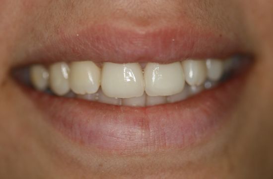 After -Optima Dental Care