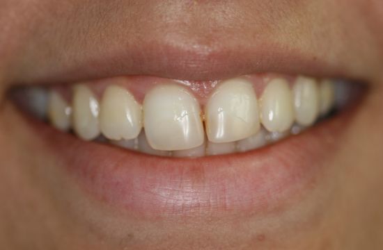 Before -Optima Dental Care