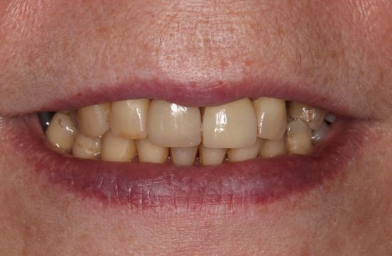 Before -Optima Dental Care