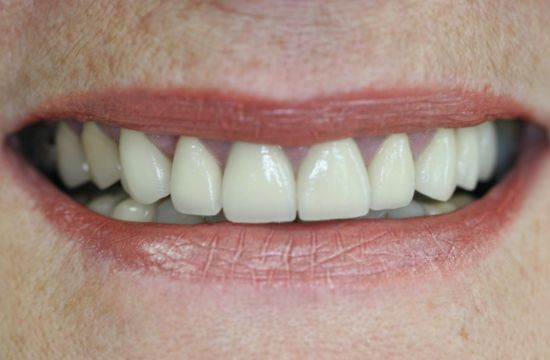 After -Optima Dental Care