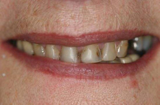Before -Optima Dental Care