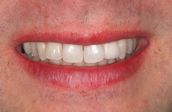 After -Optima Dental Care