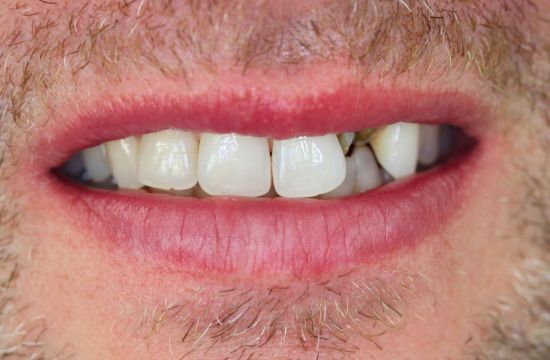 Before -Optima Dental Care