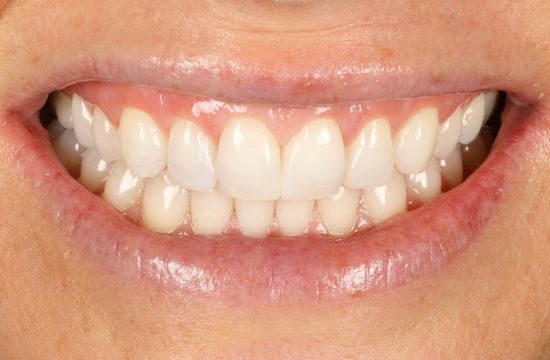 After -Optima Dental Care