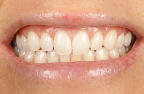Before -Optima Dental Care