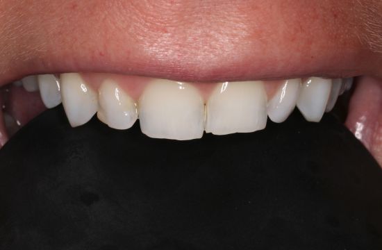 Before -Optima Dental Care